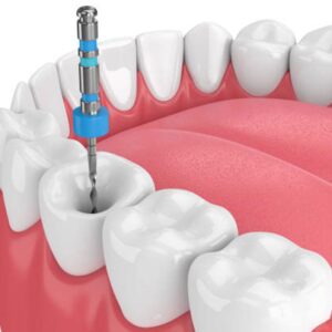 Kanal Tedavisi (Endodonti)